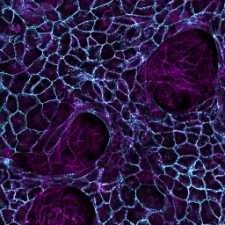 Biophysics of Epithelial Growth and Tumorigenesis